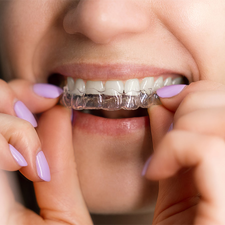 Clear Aligner Treatment in Champaign IL - Shafer Orthodontics