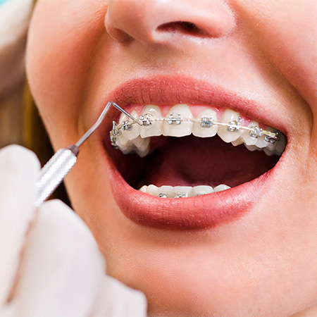 traditional-braces-shafer-orthodontics